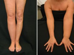 Что такое лимфедема?