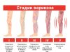 Особенности лечения варикоза