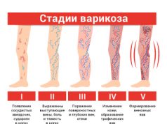 Особенности лечения варикоза