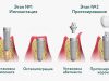 Особенности установки зубных имплантов