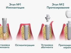 Особенности установки зубных имплантов