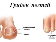 Как лечатся грибковые инфекции?