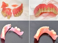 Что делать если выпал зубной протез?