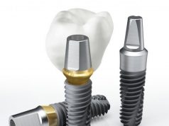 Какие зубные импланты лучше выбрать?