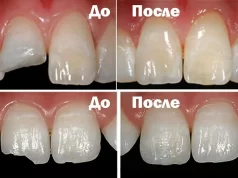 Когда необходимо сделать реставрацию зубов?