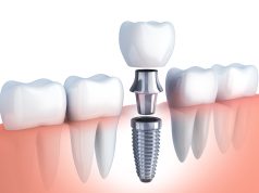 Имплантация зубов