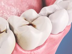 Причины развития кариеса зубов