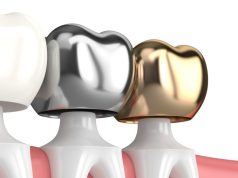 Чем интересны металлические коронки на зубы