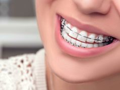 Брекеты для взрослых: как сделать правильный выбор?