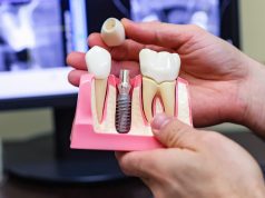 Имплантация зубов: современный и высокоэффективный способ восстановления зубов