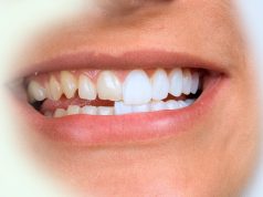 Можно ли поставить виниры на передние 4 зуба?