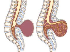 Как попасть на лечение Спина Бифида в Израиль?
