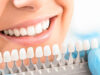 Какой метод отбеливания зубов лучше выбрать в стоматологии?