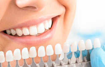 Какой метод отбеливания зубов лучше выбрать в стоматологии?