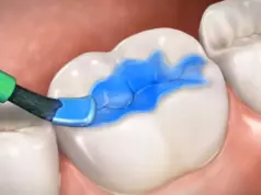 Герметизация фиссур: Защита зубов от кариеса и других неприятностей