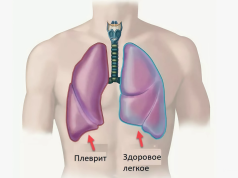 Плеврит легких — что это такое